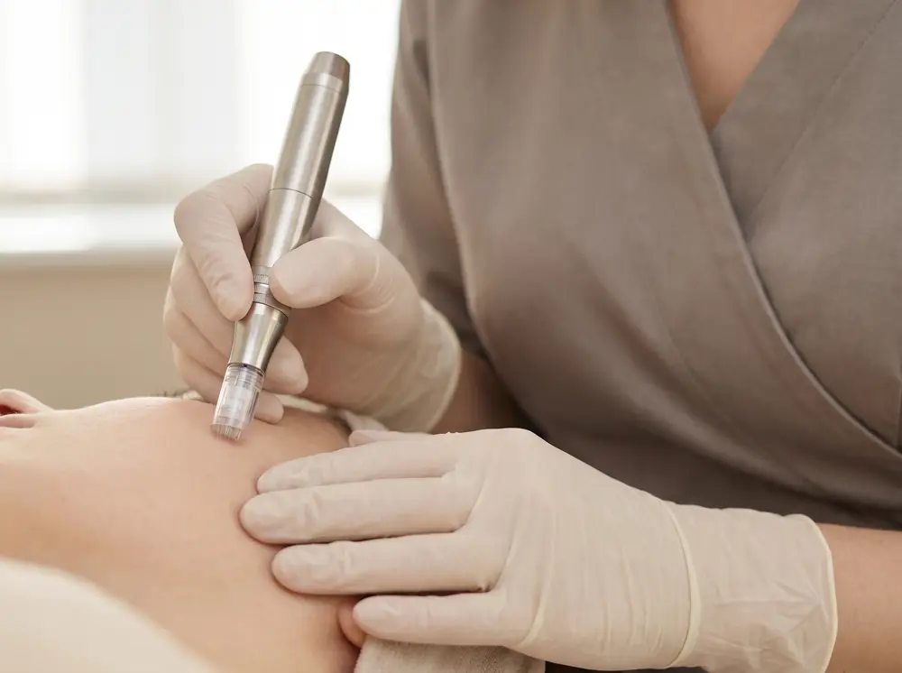 Aplicación de mesoterapia facial con dispositivo de microagujas sobre la piel