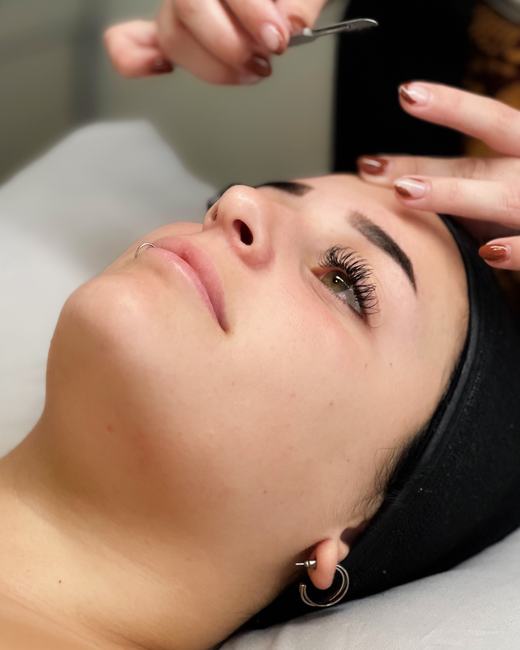 Sesión Dermapeel